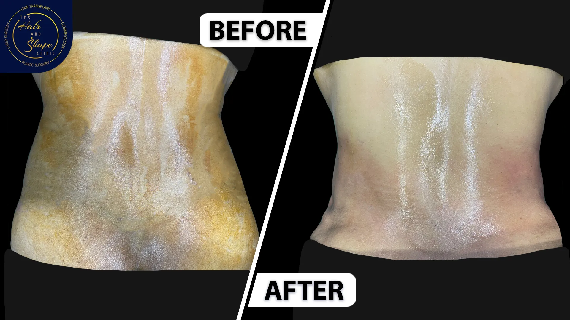 Back Liposuction result2